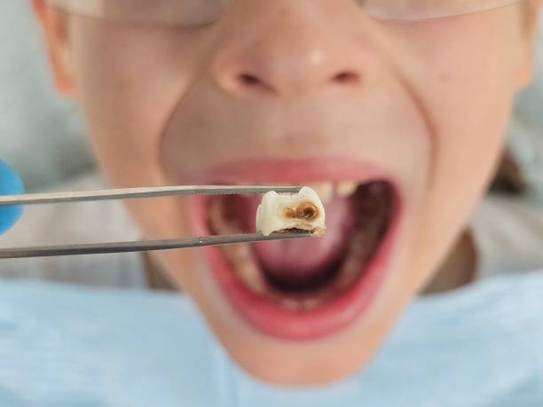 Best Lost Filling or Crown Replacement in Jeanerette, LA